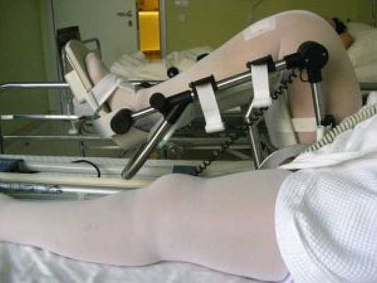 Реабилитация пациентов после протезирования коленного сустава
