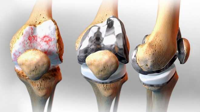 О протезировании коленного сустава