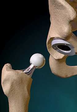 О протезах и операции эндопротезирования тазобедренного сустава