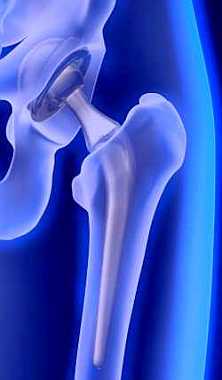 Информация для тех, кому показана операция эндопротезирования тазобедренного сустава