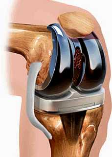 Одномоментное эндопротезирование коленных суставов